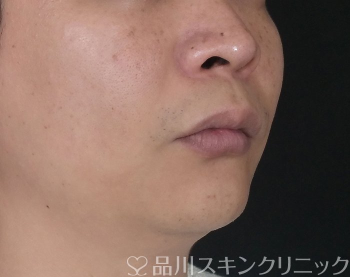 症例NO.70031のBEFORE写真