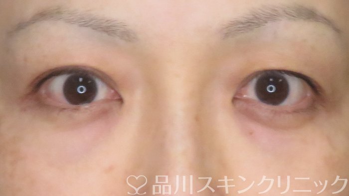 症例NO.67100のAFTER写真