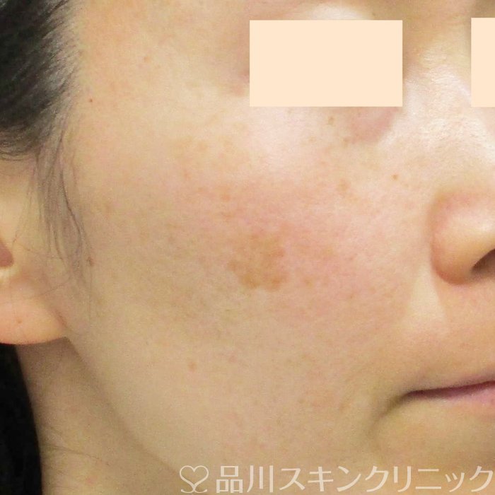 症例NO.69231のBEFORE写真