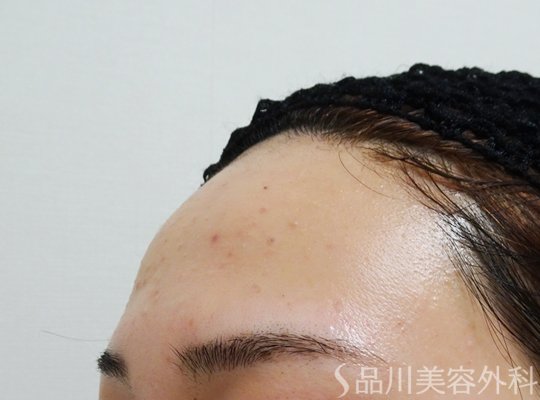 症例NO.71186のBEFORE写真