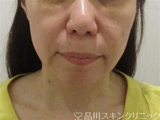 症例NO.37793のBEFORE写真
