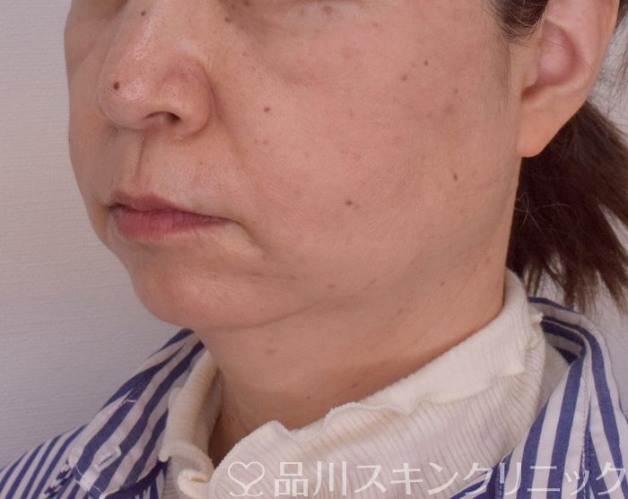 症例NO.69420のAFTER写真