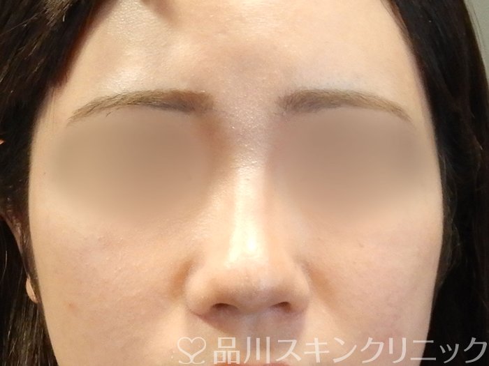 症例NO.65171のAFTER写真
