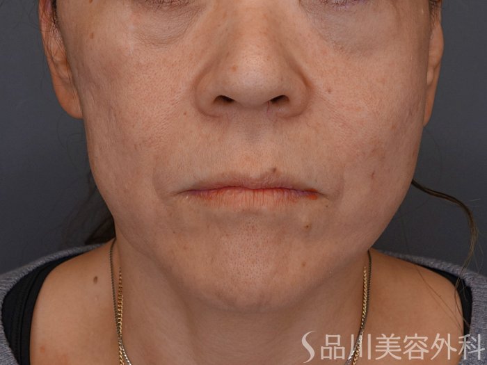 症例NO.74779のBEFORE写真