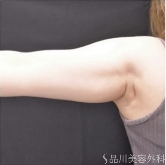 症例NO.66871のBEFORE写真