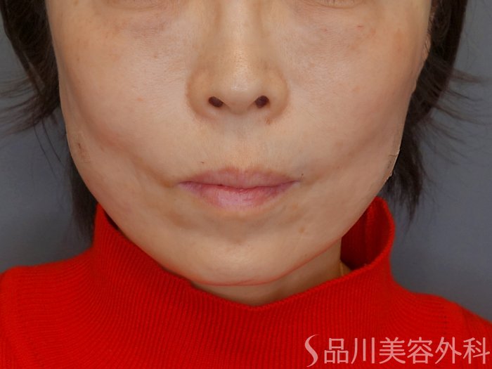症例NO.73062のAFTER写真
