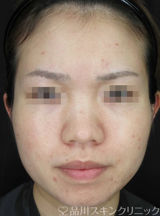 症例NO.67588のBEFORE写真