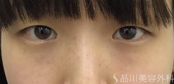 症例NO.52439のBEFORE写真
