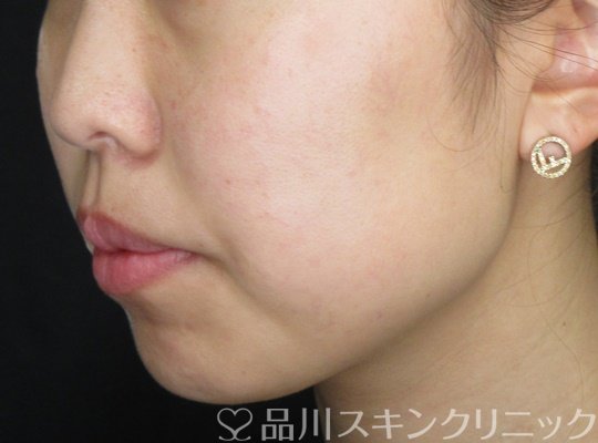 症例NO.70309のAFTER写真