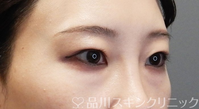 症例NO.72190のBEFORE写真