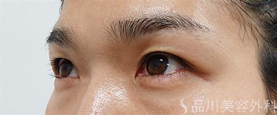 症例NO.53744のBEFORE写真