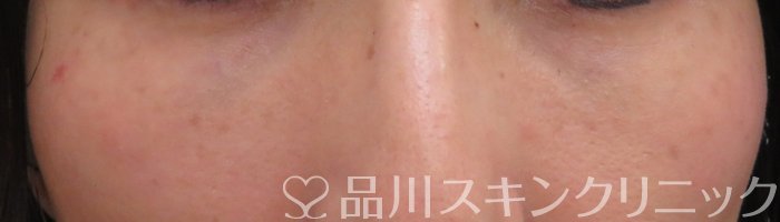症例NO.66423のAFTER写真