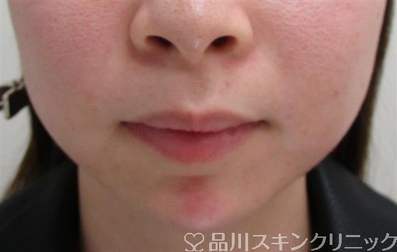 症例NO.34648のAFTER写真