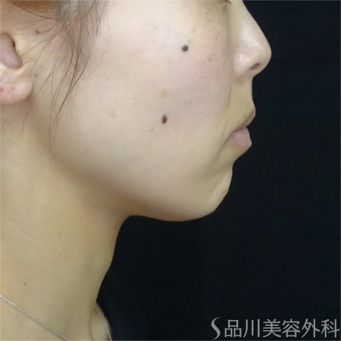 症例NO.70166のBEFORE写真