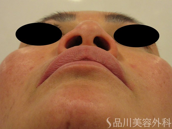 症例NO.75205のBEFORE写真