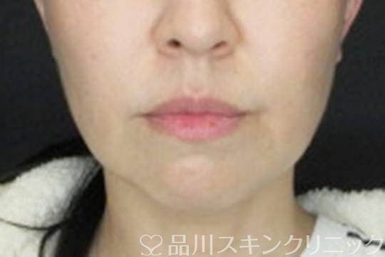 症例NO.72622のBEFORE写真