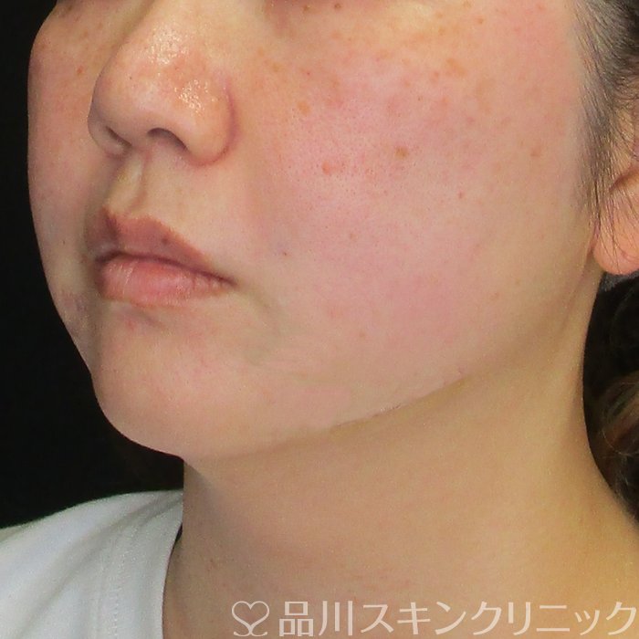 症例NO.72947のAFTER写真