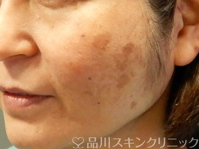 症例NO.69180のBEFORE写真
