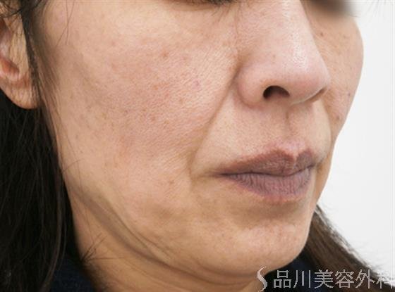 症例NO.25629のAFTER写真