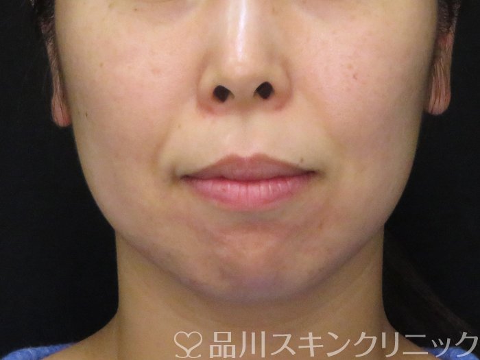 症例NO.67926のBEFORE写真
