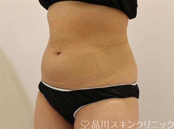 症例NO.47298のAFTER写真