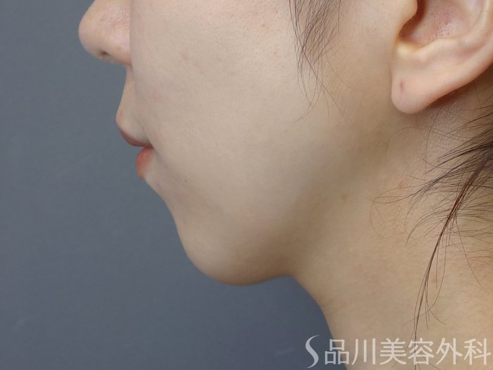症例NO.74638のBEFORE写真
