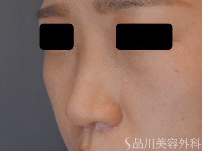 症例NO.72213のBEFORE写真