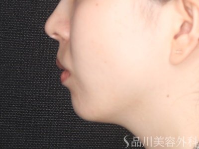 症例NO.70399のBEFORE写真