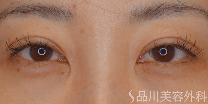 症例NO.69563のAFTER写真