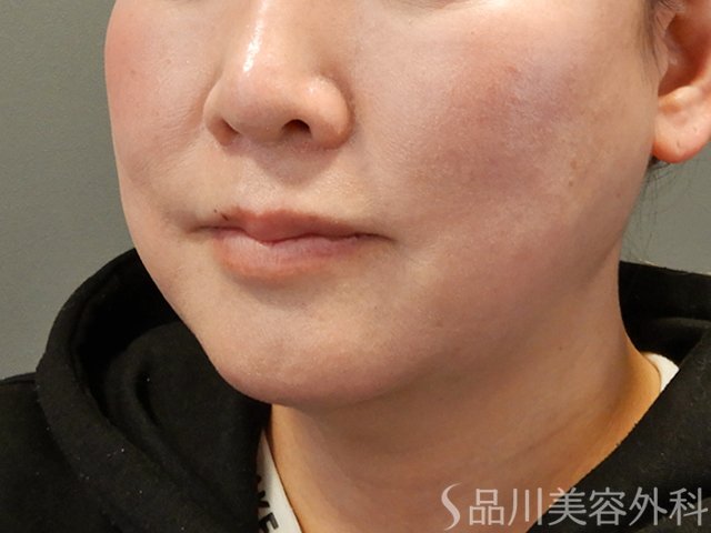 症例NO.75064のBEFORE写真