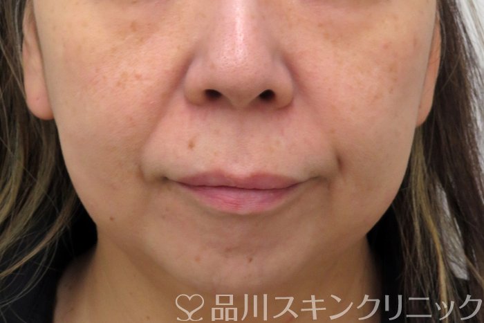 症例NO.74160のBEFORE写真