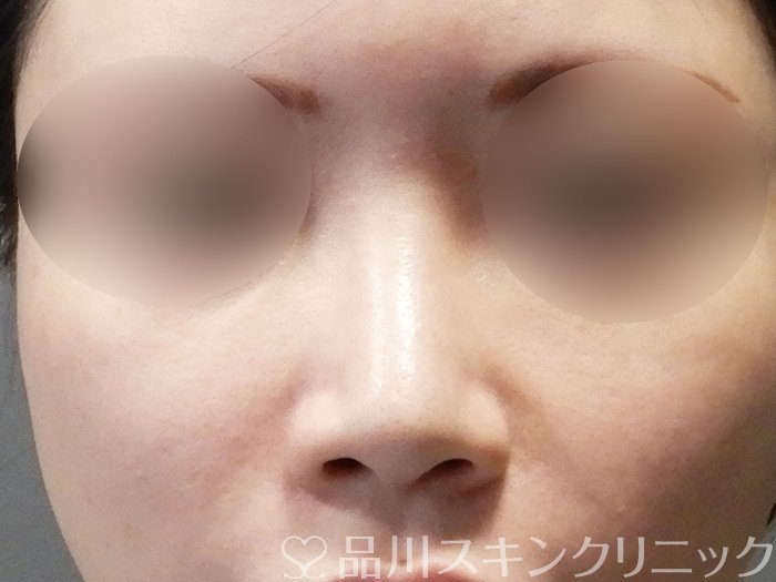 症例NO.72813のBEFORE写真