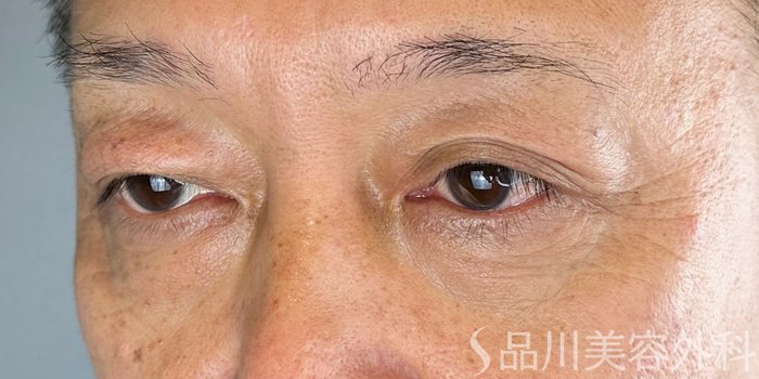 症例NO.68511のBEFORE写真
