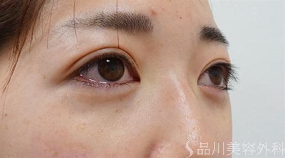 症例NO.50762のAFTER写真