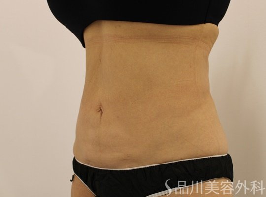 症例NO.71702のAFTER写真