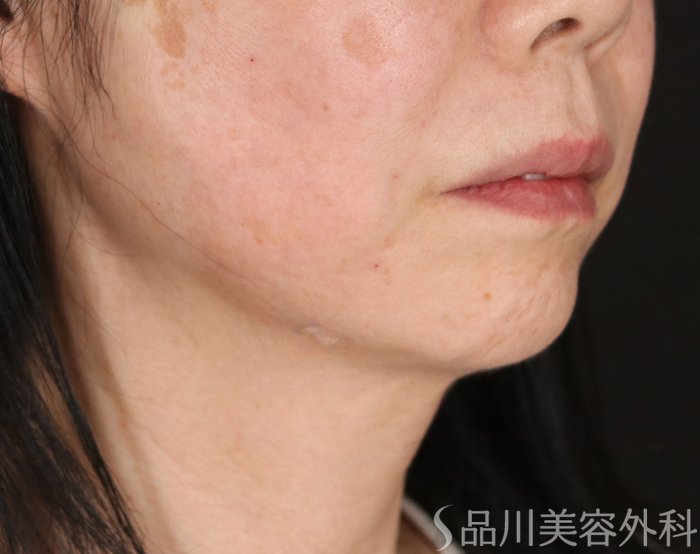 症例NO.73639のAFTER写真