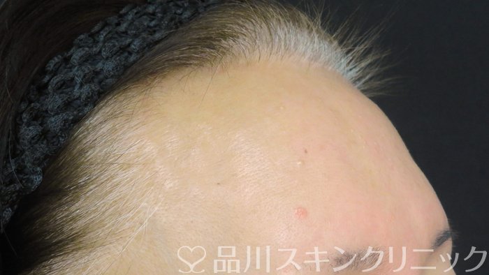 症例NO.74766のBEFORE写真
