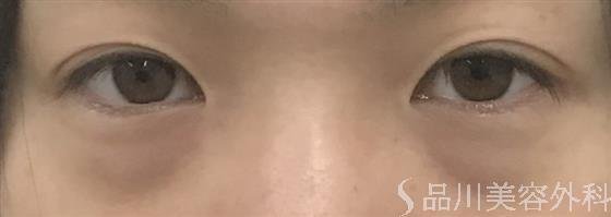 症例NO.46567のBEFORE写真