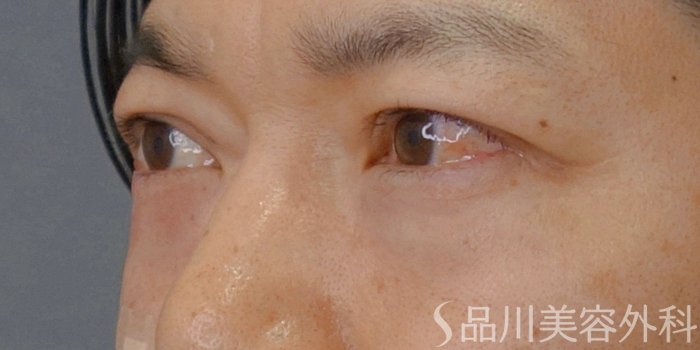 症例NO.74021のAFTER写真