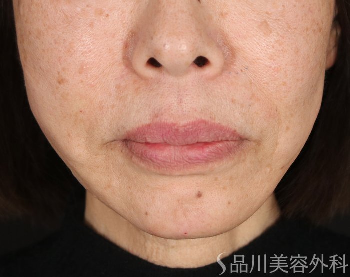 症例NO.72936のAFTER写真