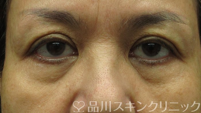 症例NO.69768のBEFORE写真