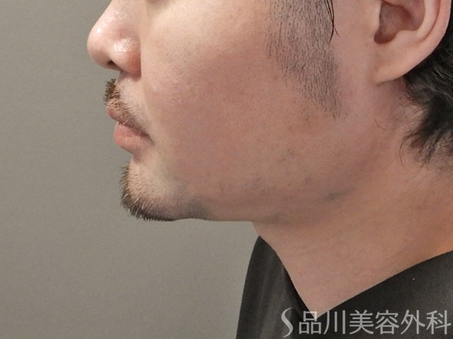 症例NO.74957のBEFORE写真