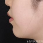 症例NO.74365のBEFORE写真