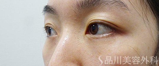 症例NO.69882のAFTER写真