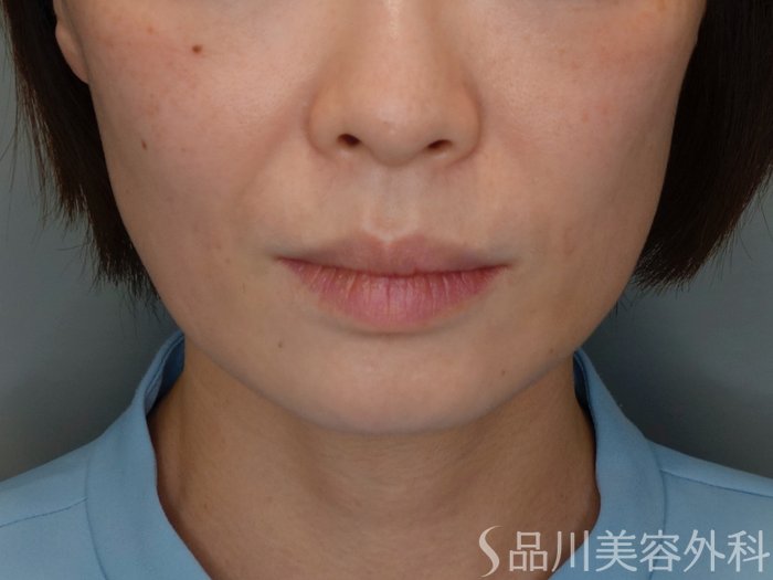 症例NO.69471のBEFORE写真