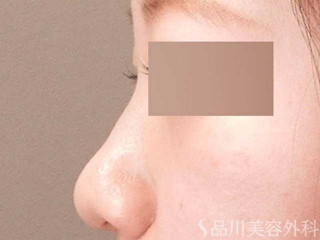 症例NO.70723のBEFORE写真