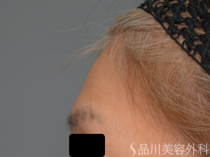 症例NO.70706のBEFORE写真