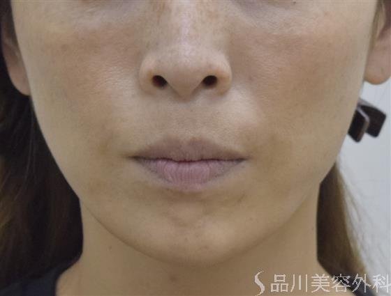 症例NO.53036のAFTER写真
