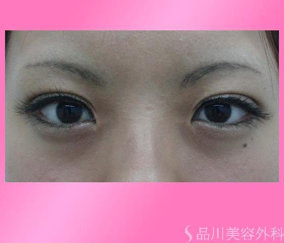 症例NO.3247のAFTER写真