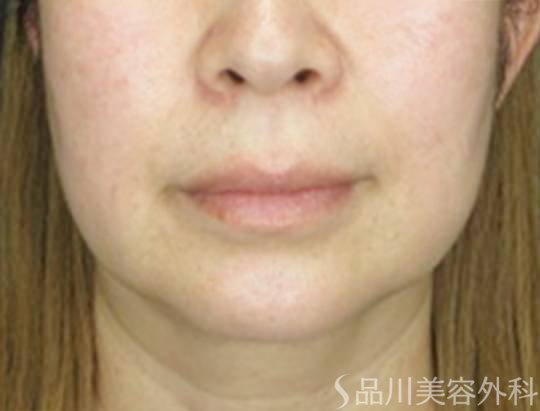 症例NO.73251のBEFORE写真